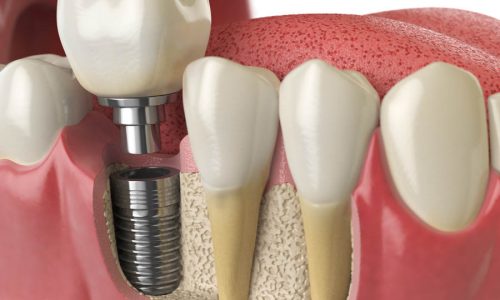 Anatomy of healthy teeth and tooth dental implant in human dentu